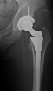 Hip-replacement